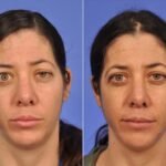 Thyroid Eye Disease Before and After